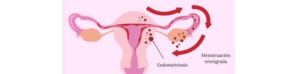 Esquema de la menstruación retrógrada